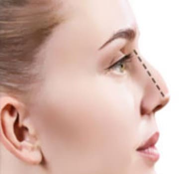 Septumplastia